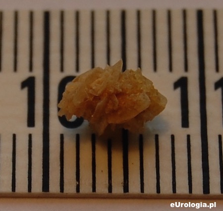 Kamień wydalony przez pacjenta
