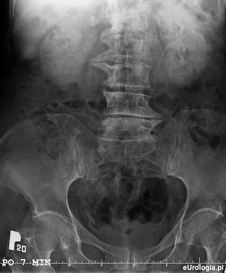 Kamica dolnego odcinka prawego moczowodu