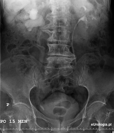 Wodonercze - duży kamień w moczowodzie