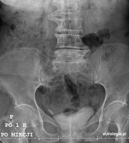 Urografia - kamica moczowodowa