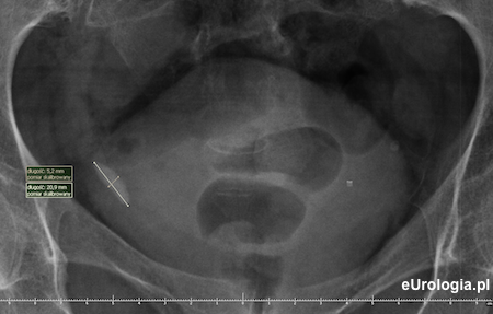 Kamień w dolnym odcinku moczowodu - urografia