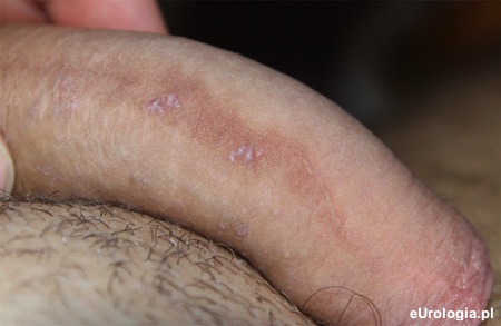 Białe plamki na sk&oacute;rze penisa