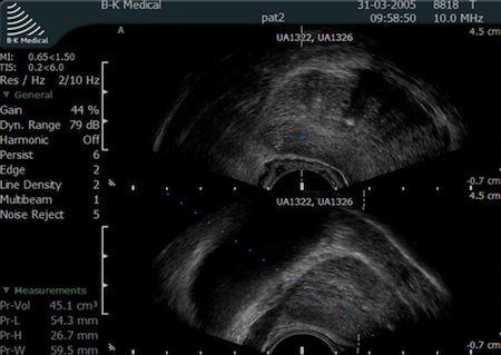 Biopsja gruczołu krokowego - TRUS+B