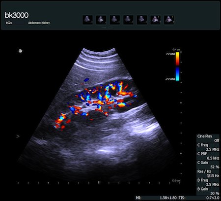 Przekr&oacute;j strzałkowy nerki - bk3000