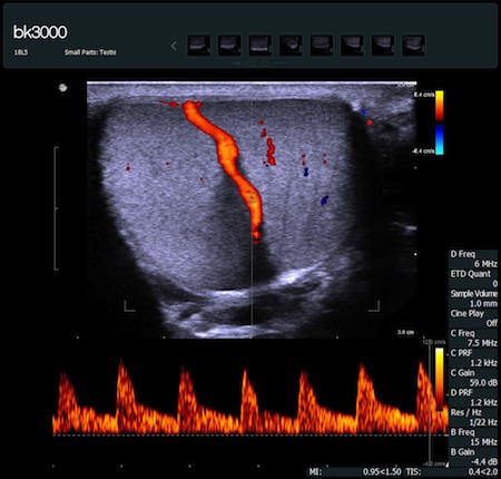 bk3000 - obraz jądra w opcji PW Doppler