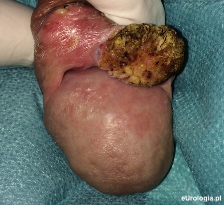 Rak prącia - Carcinoma planoepitheliale keratodes