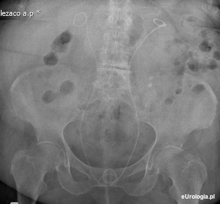 Cewniki JJ - DJ w obu nerkach u pacjentki z wypadaniem narządu rodnego