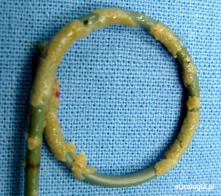 Cewnik DJ pokryty solami mineralnymi