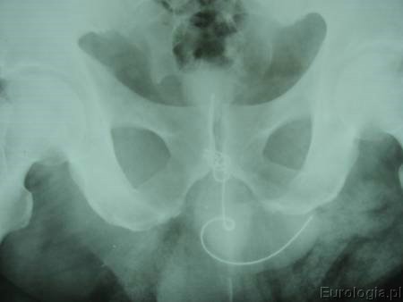 Ciało obce pęcherza moczowego i cewki - RTG przeglądowe nerek i pęcherza