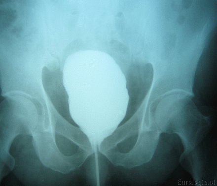 Cystografia - obraz prawidłowy