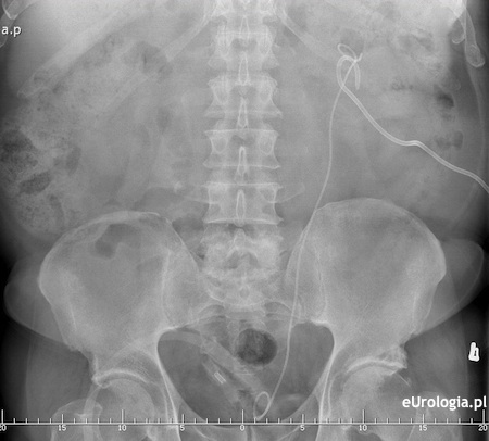Cewnik DJ i nefrostomia