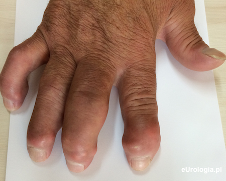 Dna moczanowa - palce pacjenta