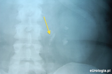 Droga kamicza - Steinstrasse
