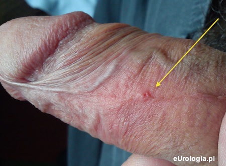 Dziurka na spodzie penisa