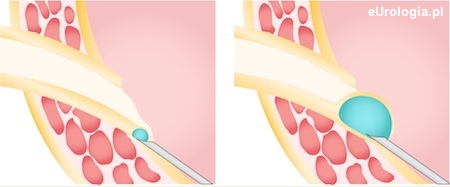 Ostrzykiwanie ujścia - Deflux