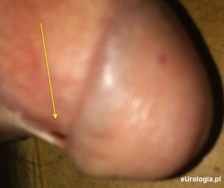 Fałd sk&oacute;ry - rowek zażołędny