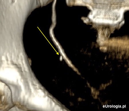 Flebolit czy kamica moczowodu - tomografia