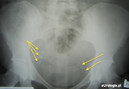 Flebolit - r&oacute;żnicowanie ze złogiem w moczowodzie