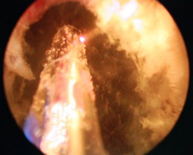 Laser zielony - widok końc&oacute;wki lasera odparowującej tkankę gruczołu krokowego