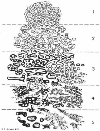 Gleason - skala Gleasona