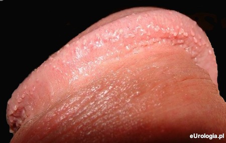 Grudki perliste prącia