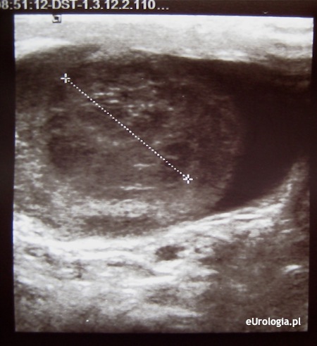 Guz jądra - obraz USG