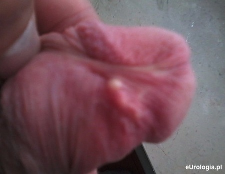 Guzki przy wędzidełku