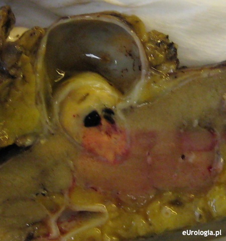 Guz w świetle torbieli prostej nerki