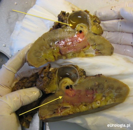 Guz w torbieli nerki