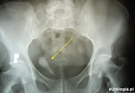 Zdjęcie przeglądowe - kamica kikuta moczowodu