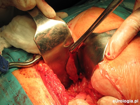 Operacja usunięcia kikuta moczowodu