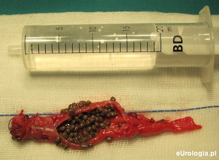 Złogi w kikucie moczowodu
