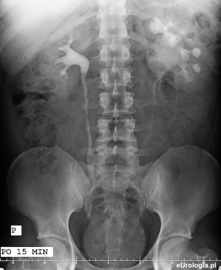 Kamica lewego moczowodu i naczynie doatkowe nerki