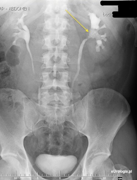 Kamica odlewowa lewej nerki