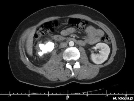 Kamica odlewowa nerki prawej - skan z tomografii komputerowej.