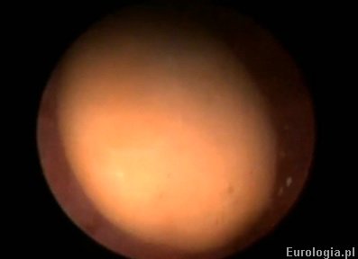 Kamica pęcherza - zł&oacute;g widoczny w czasie endoskopowego usunięcia