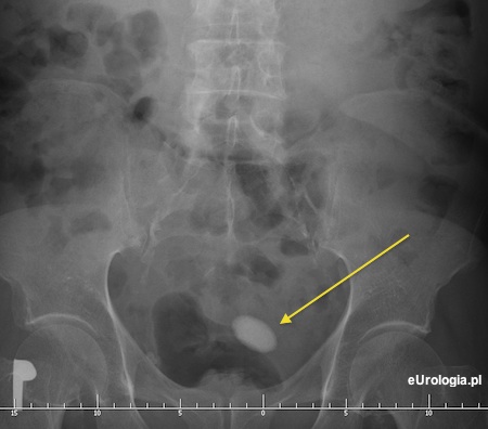 Kamica pęcherza moczowego - cień złogu na zdjęciu RTG