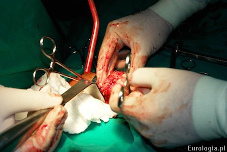 Cystolitotomia - operacja kamicy pęcherza moczowego