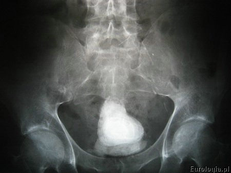 Kamica pęcherza moczowego - zdjęcie przeglądowe