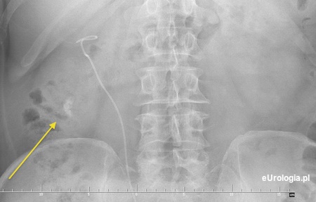 Kamica resztkowa po ESWL
