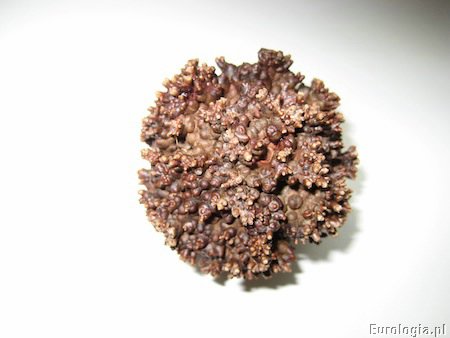 Kamica pęcherza moczowego