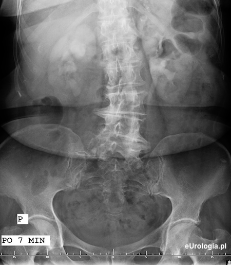 Kamica moczowodowa prawostronna