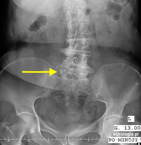 Kamień w moczowodzie - staw krzyżowo-biodrowy
