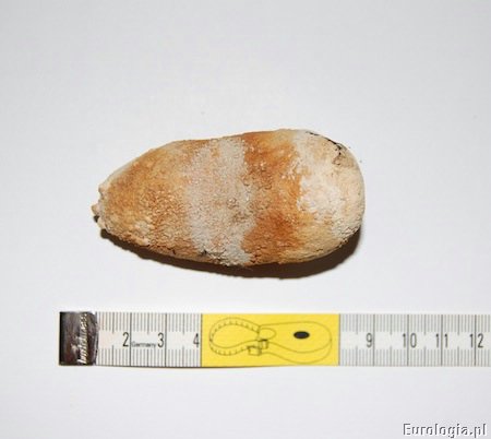 Kamica pęcherza moczowego