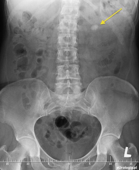 Zł&oacute;g 2 cm w miedniczce nerki lewej