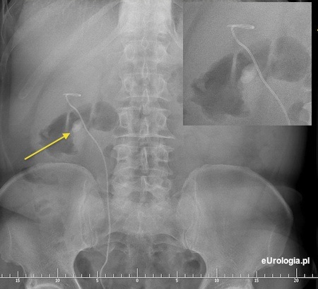 Kamień w miedniczce przed ESWL