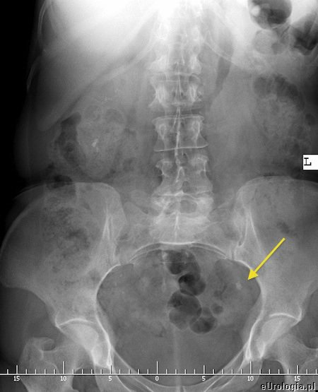 Zł&oacute;g w lewym moczowodzie