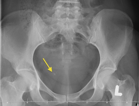 Kamień w dolnym odcinku prawego moczowodu