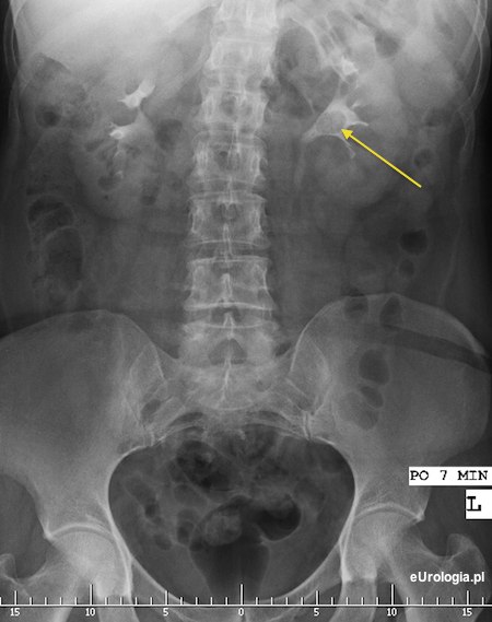 Zł&oacute;g 12 w miedniczce nerkowej.