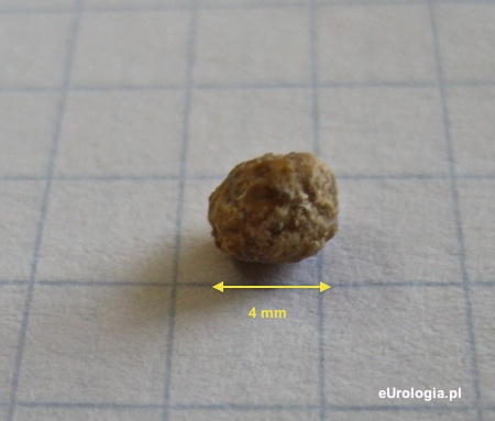 Złog 4 mm wydalony z moczowodu